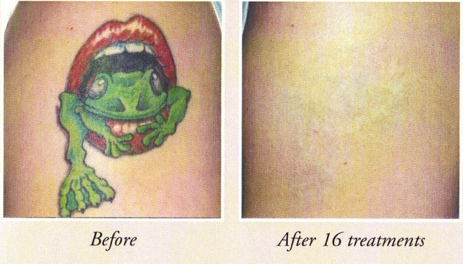 Affordable Tattoo Removal | using Infrared Light